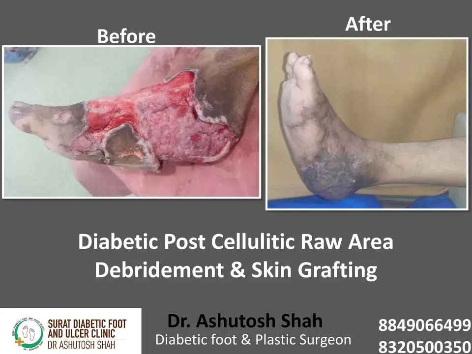 Diabetic Foot  PPT sunita.pptx-34.webp